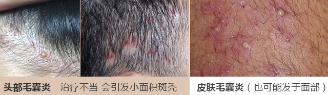 南京肤康皮肤医院毛囊炎的病因有哪些