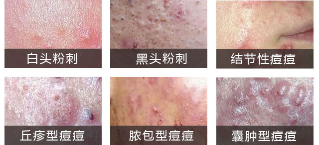 南京肤康皮肤医院青春痘会给患者造成哪些危害