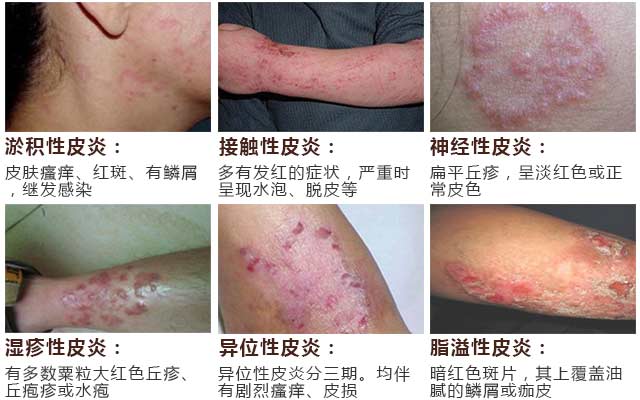 南京肤康皮肤医院如何避免皮肤过敏的发生