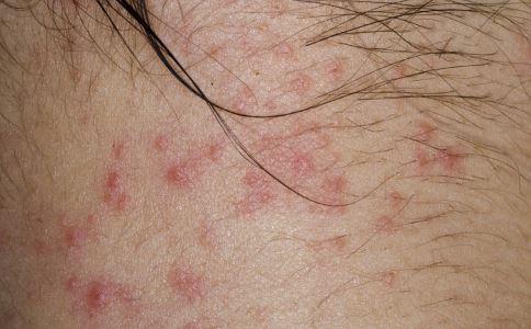 南京肤康皮肤医院皮炎的治疗原则是什么？