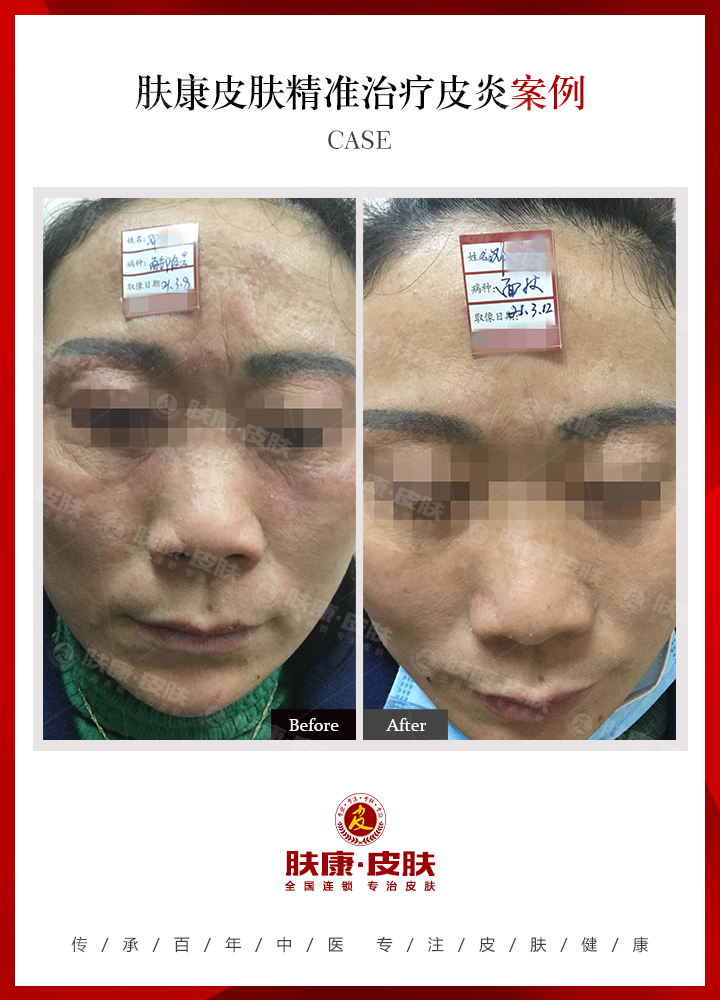 南京肤康皮肤医院季节性皮炎该如何预防
