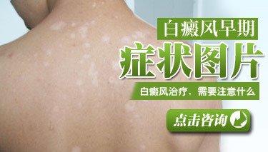 南京肤康皮肤医院白癜风长期不治有什么危害？