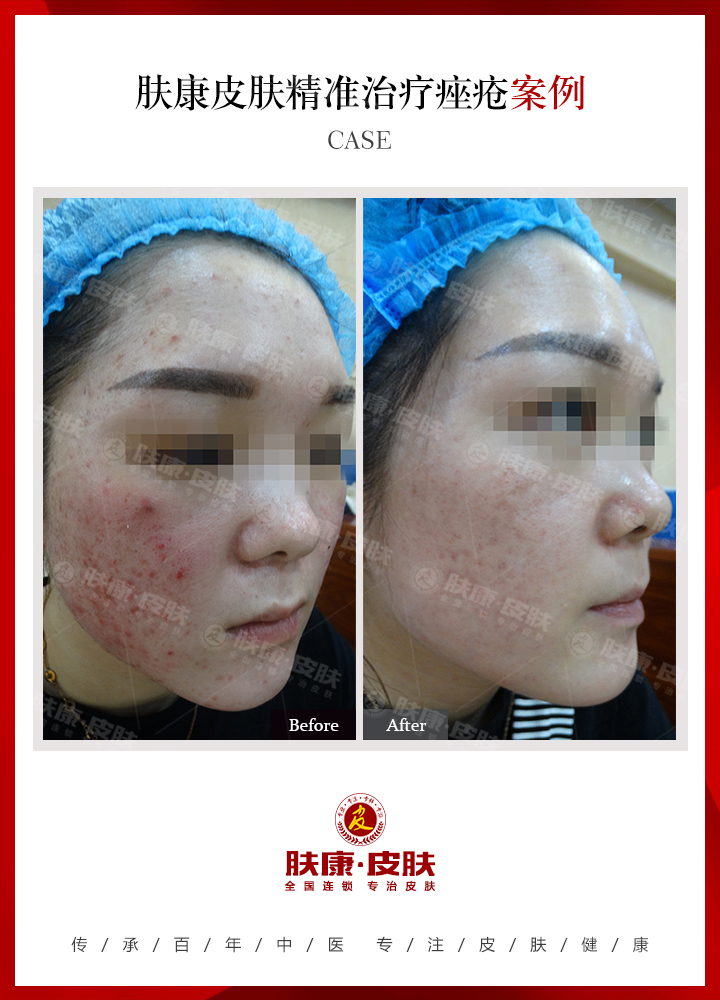 南京肤康皮肤医院青春痘的预防方法都有些什么