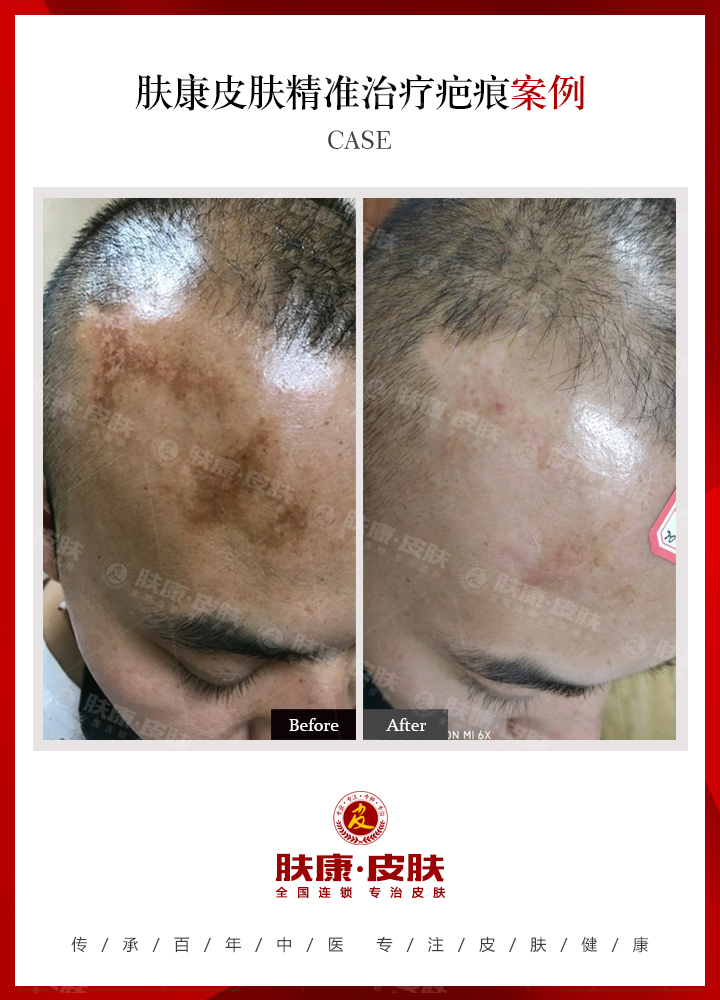 南京肤康疤痕需要多少钱呢？